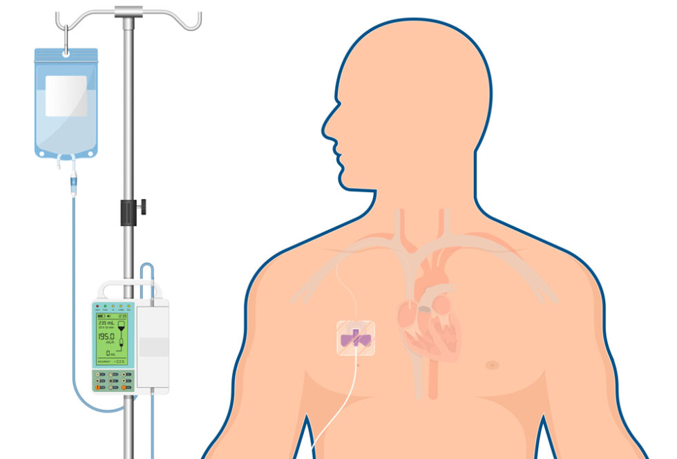 Parenterale Ernährung/ Infusionstherapie | Mevice